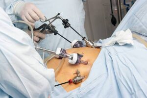 عمل اسلیو معده چیست و چگونه باعث کاهش وزن می‌شود؟